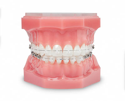 clear braces ceramic brackets