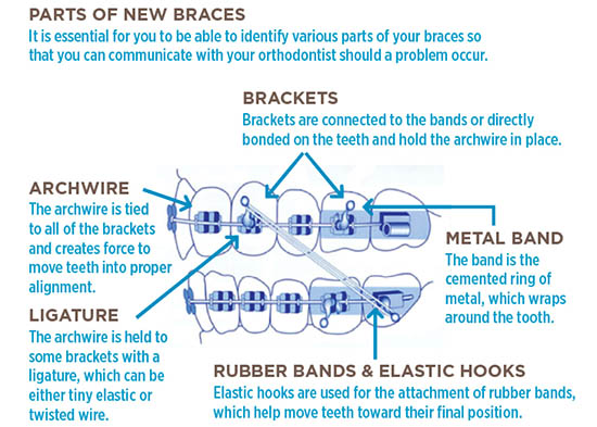 BHO-Braces Diagram Final